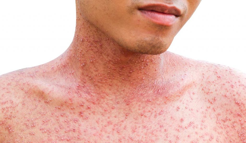 В Гродно — случай заболевания корью: студент привез инфекцию из Польши