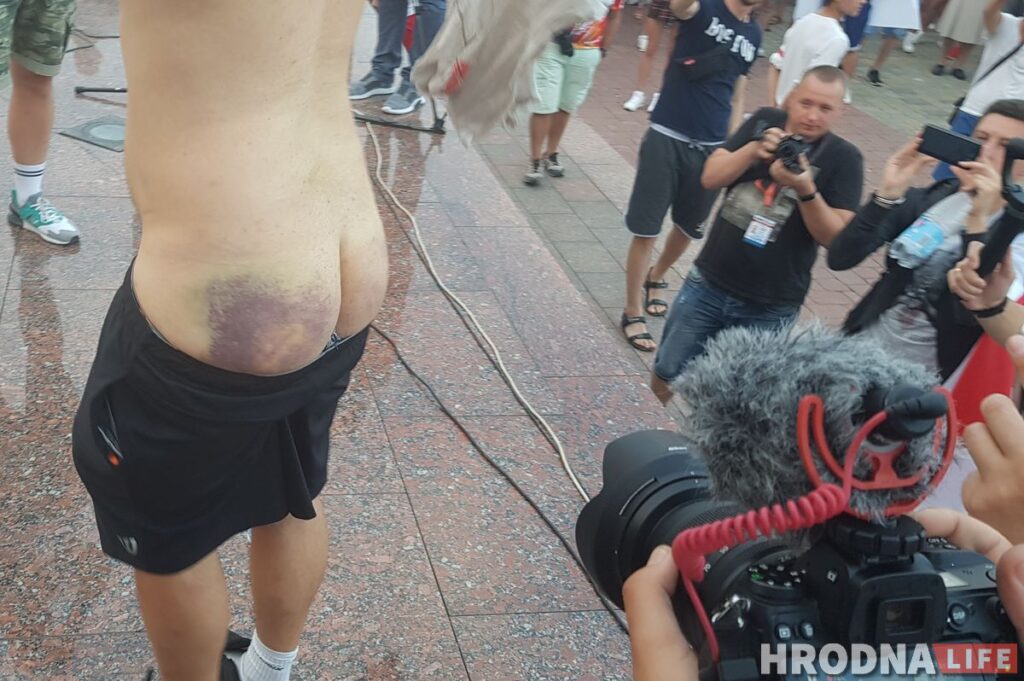 «Пришлось удалить глаз», «бросали головой вниз», «на спине табличка в крестики-нолики». Медики из Гродно — о травмах пострадавших от ОМОНа