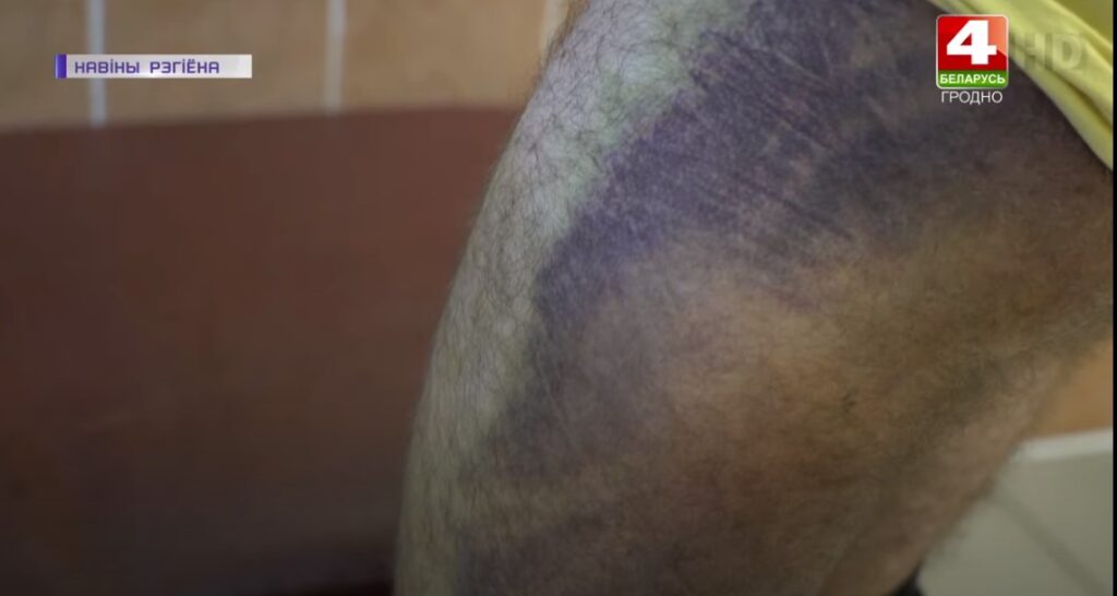 «Пришлось удалить глаз», «бросали головой вниз», «на спине табличка в крестики-нолики». Медики из Гродно — о травмах пострадавших от ОМОНа