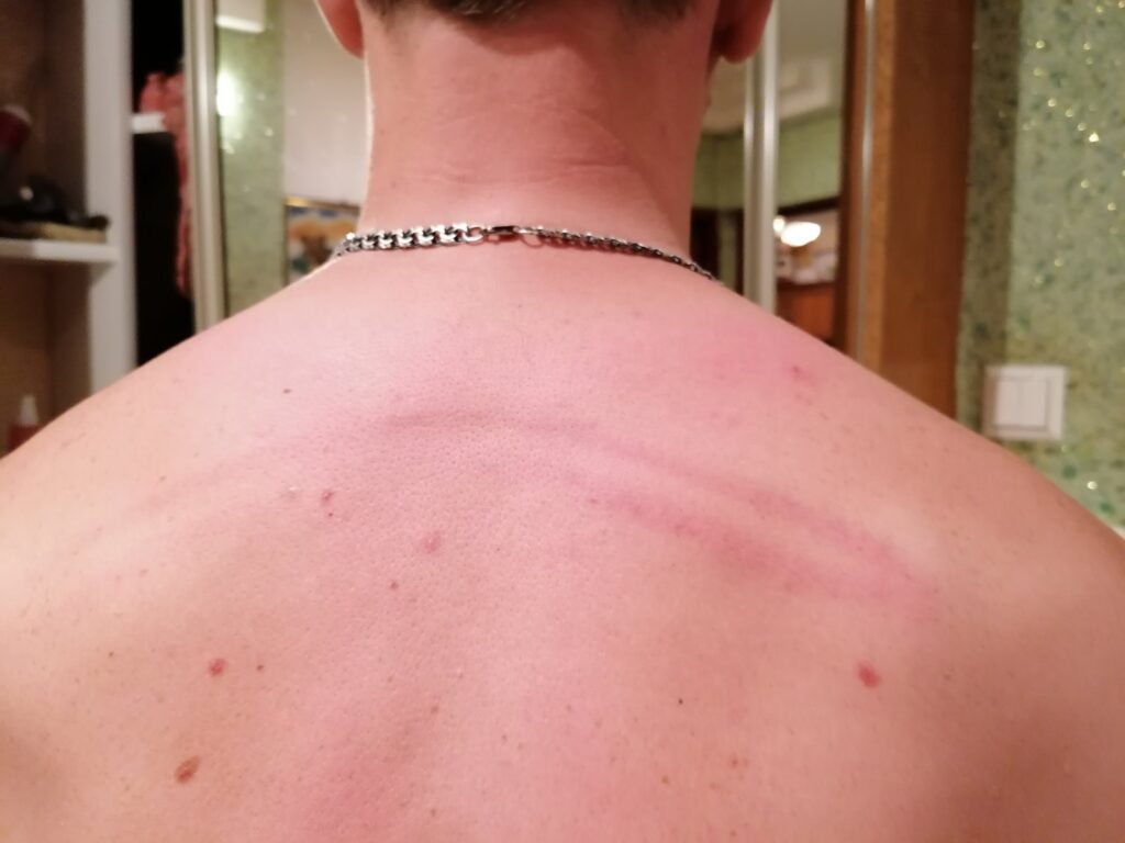 «Мы любого убьем, но вам город не отдадим». О чем рассказали гродненцы, пришедшие снимать побои в судмедэкспертизу