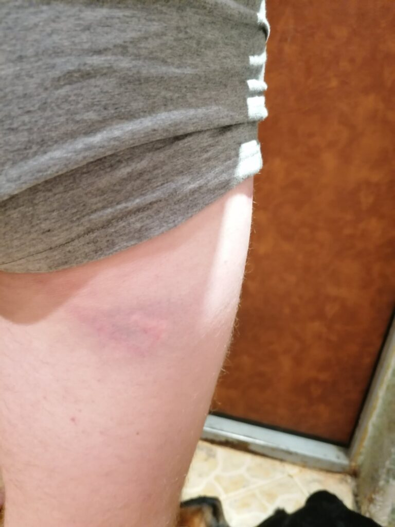 «Мы любого убьем, но вам город не отдадим». О чем рассказали гродненцы, пришедшие снимать побои в судмедэкспертизу