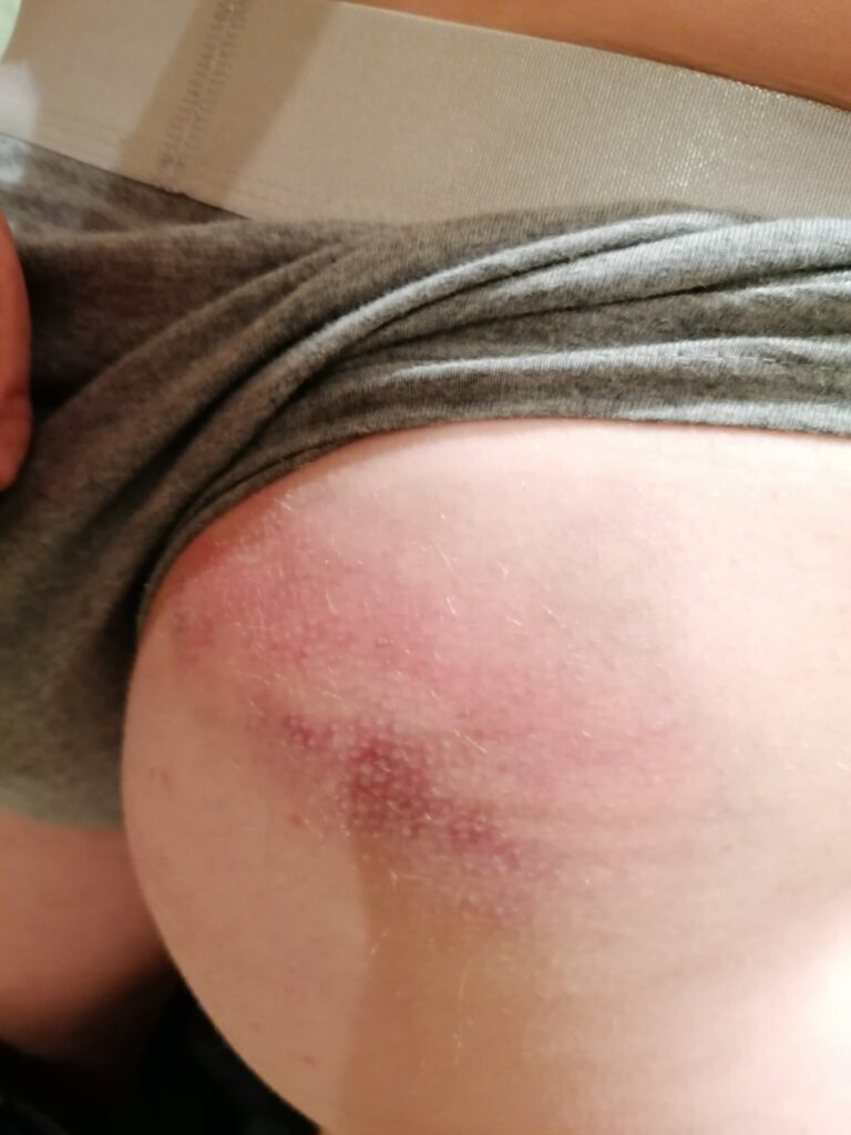 «Мы любого убьем, но вам город не отдадим». О чем рассказали гродненцы, пришедшие снимать побои в судмедэкспертизу