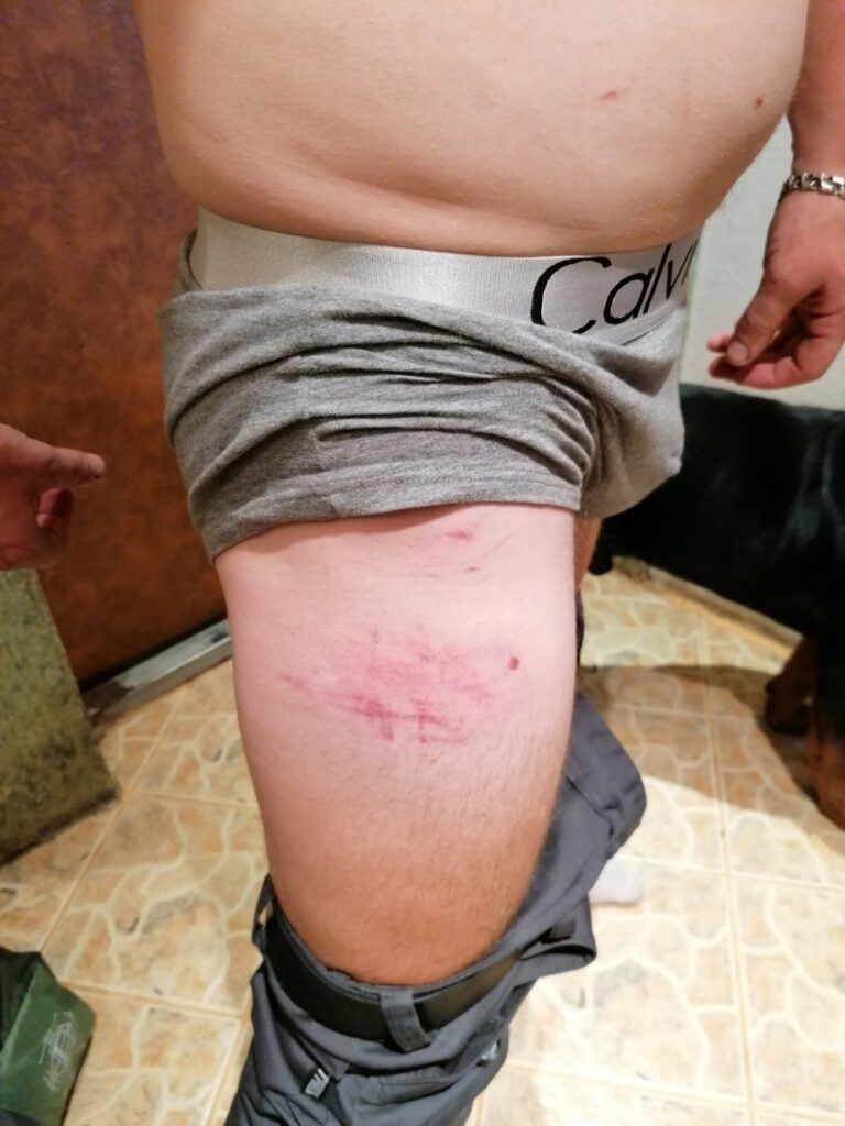 «Мы любого убьем, но вам город не отдадим». О чем рассказали гродненцы, пришедшие снимать побои в судмедэкспертизу