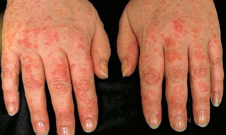 Аквагенная крапивница